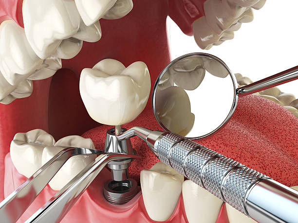 Best Broken or Chipped Tooth Repair in Central Islip, NY